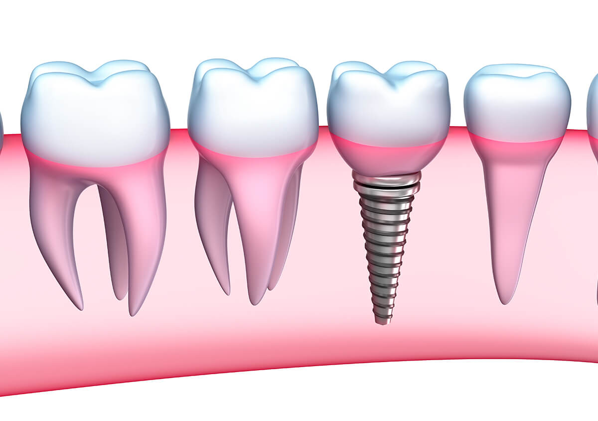 Teeth Implants in Acton MA Area