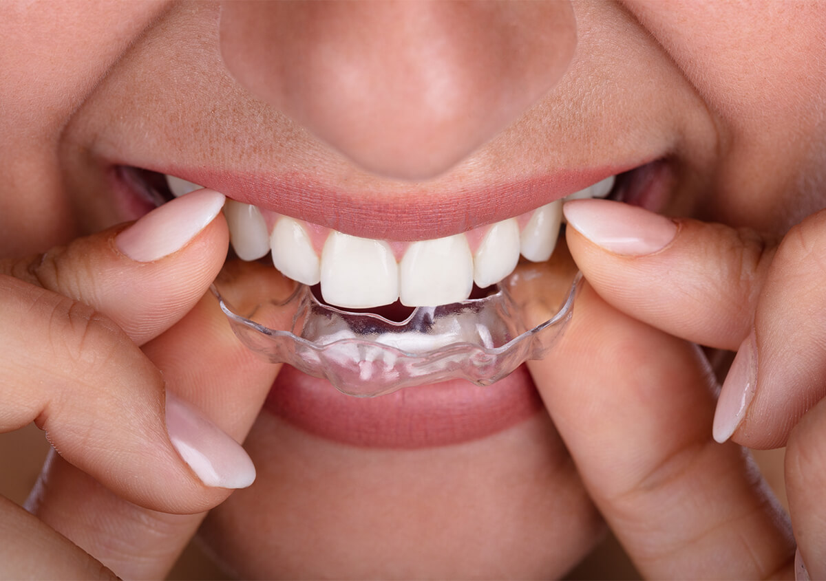 Clear Teeth Aligners in Acton MA Area