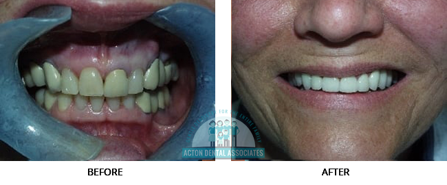 Crowns - Before and After Actual patient result image 2 at Acton Dental Associates, MA