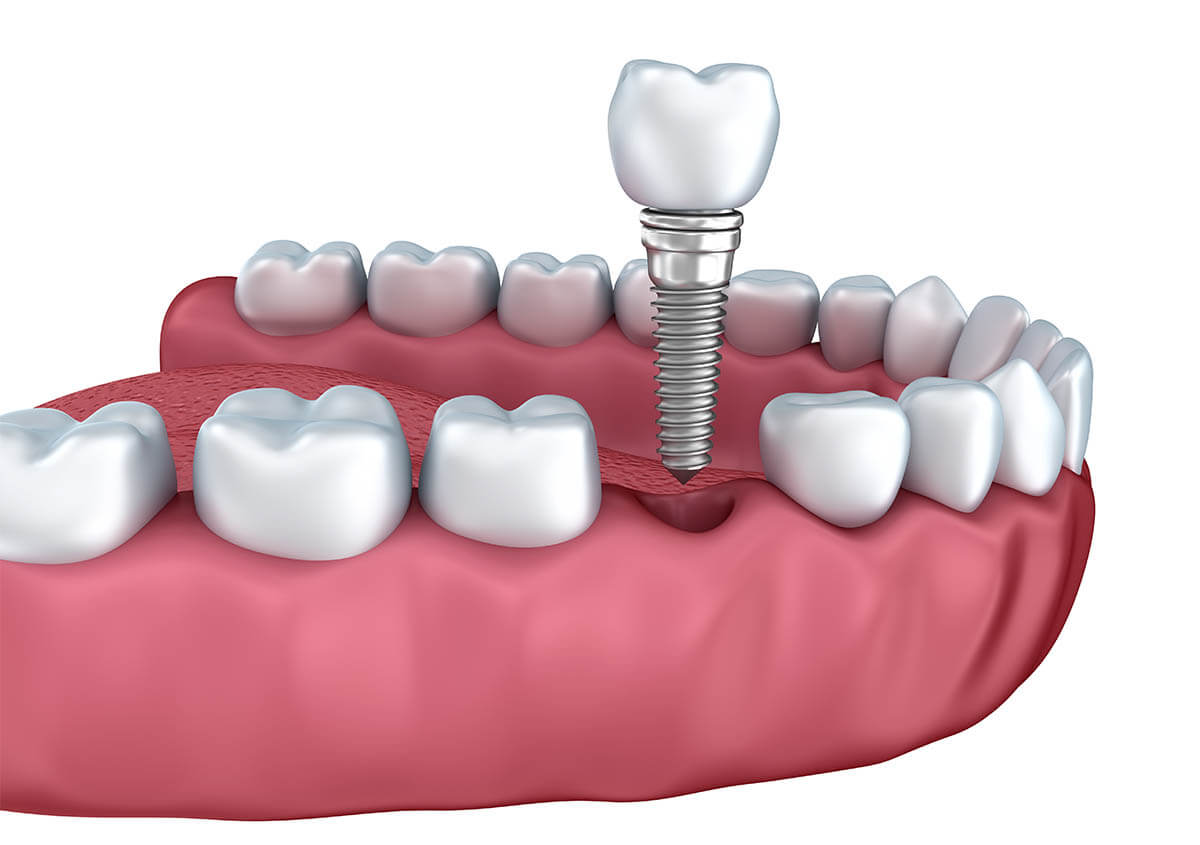 Dentist for Teeth Implants in Acton MA Area