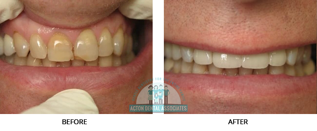 Porcelain Veneers - Before and After Actual patient result image 2 at Acton Dental Associates, MA