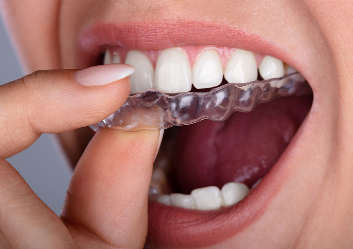 Clear Aligners at Acton Dental in Acton MA Area